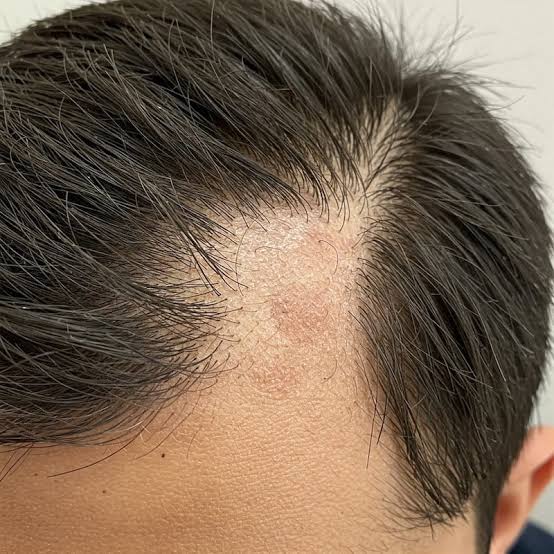 Alopecia Treatment
