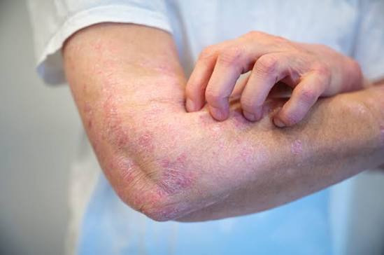 Eczema Treatment