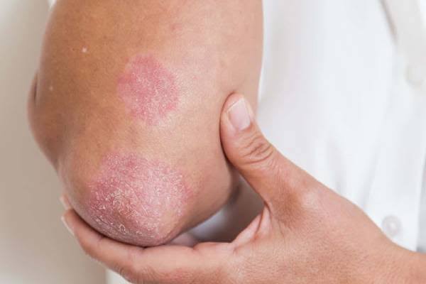 Fungal Infection Treatment