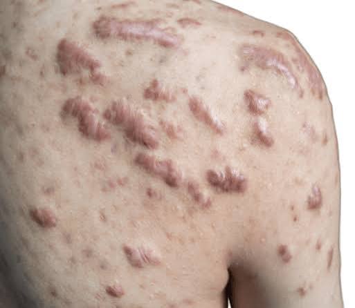 Keloid Treatment