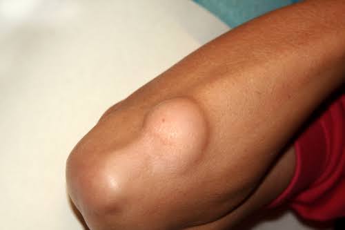 Lipoma Removal