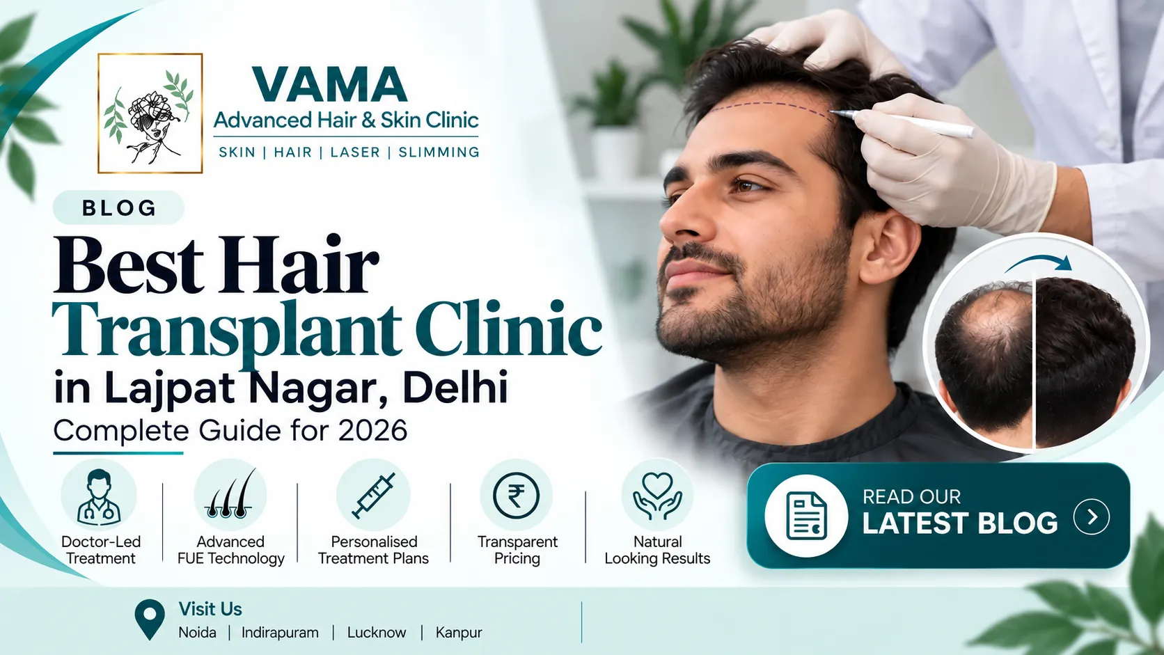 Best Hair Transplant Clinic in Lajpat Nagar, Delhi: Complete Guide for 2026