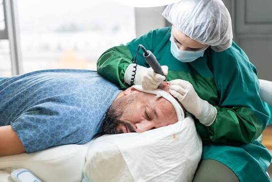 Hair Transplant (FUE)