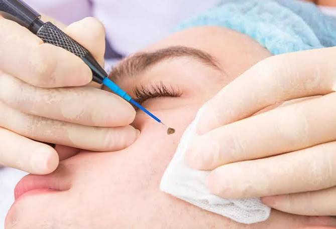 Mole / Skin Tag Removal